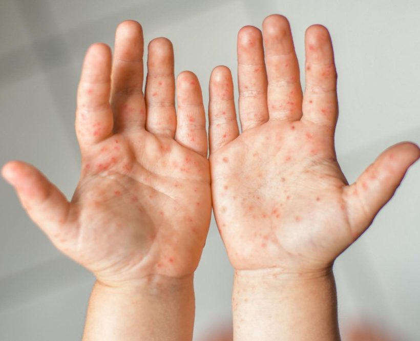 enterovirus-legs-hands-mouth-rash-body-child-cocksackie-virus