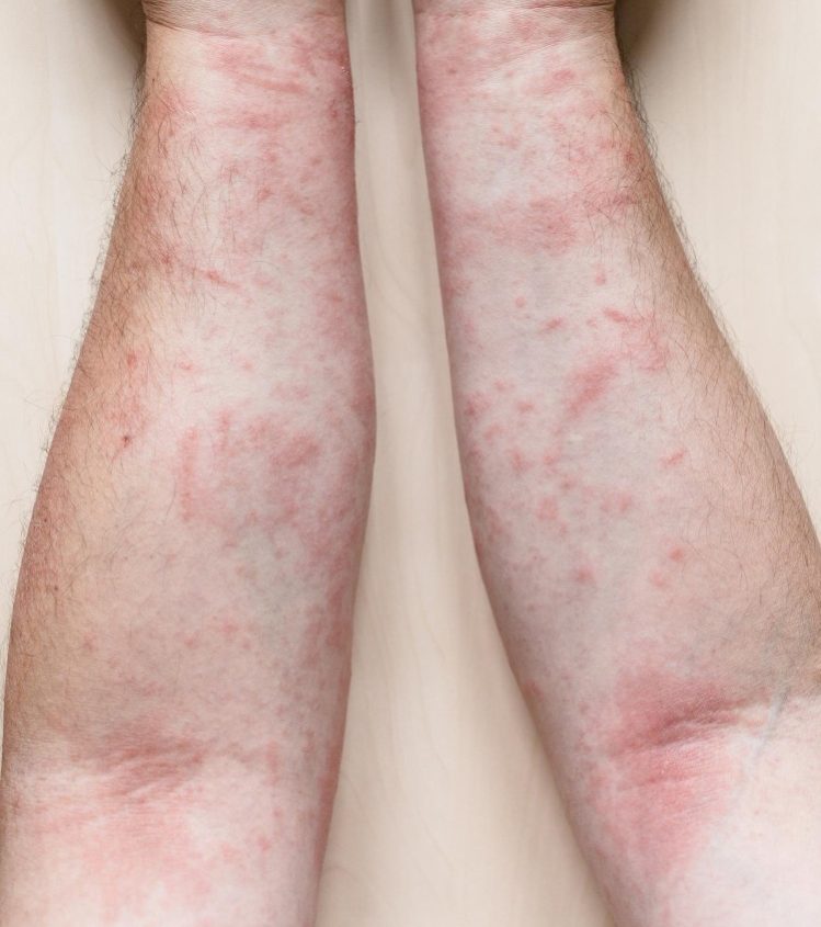 male-arms-with-itchy-red-rash