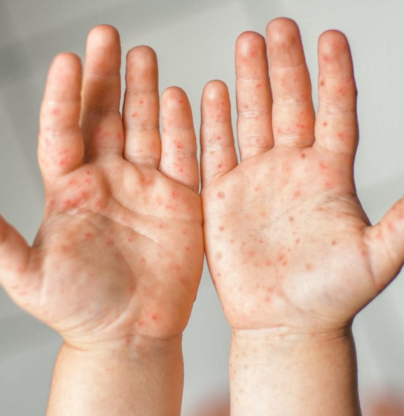 enterovirus-legs-hands-mouth-rash-body-child-cocksackie-virus