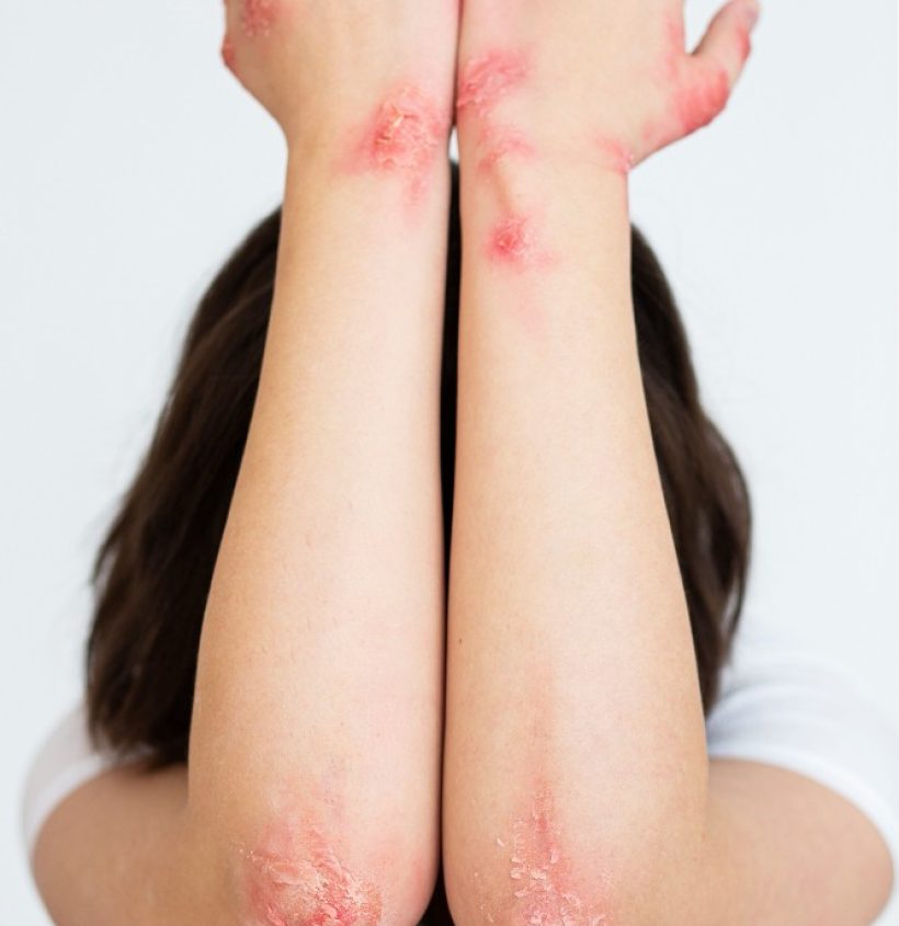 hands-patient-suffering-from-psoriasis (1)