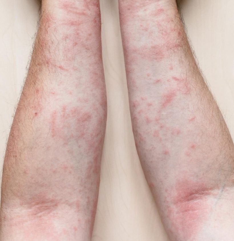 male-arms-with-itchy-red-rash