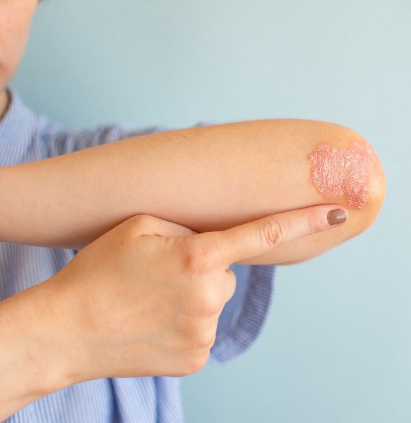 psoriasis-women-her-elbows-sitting-bedroom-floor-concept-dermatology